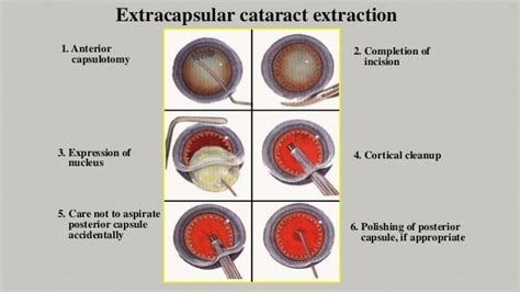 Glaucoma And Cataract Include Treatment