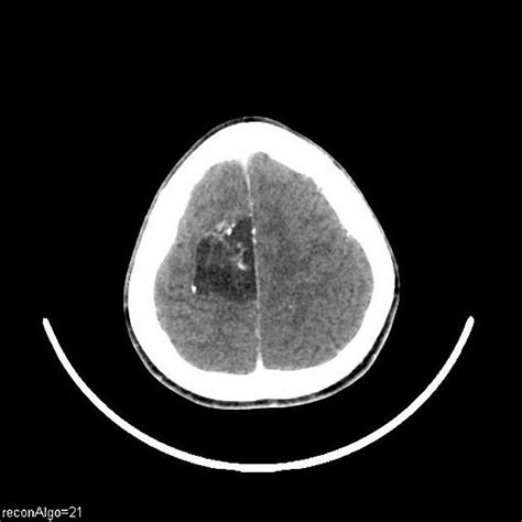 Intracranial Epidermoid Cyst Pacs