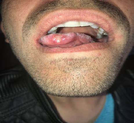 Figure 2 From Clinical Case Of A Male Patient With Oral Ulcerative