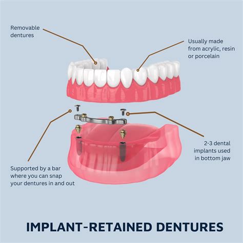 Every Type of Implant Imaginable, Costs & Finance Package