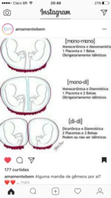Casal De Gemeos Da Mesma Placenta - GRAVIDA DE GEMEOS CASAL E COM PLACENTA UNICA | BabyCenter