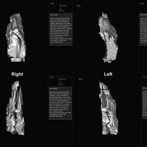 Intraoperative View Of Open Septal Reduction Using The Pds Plate A