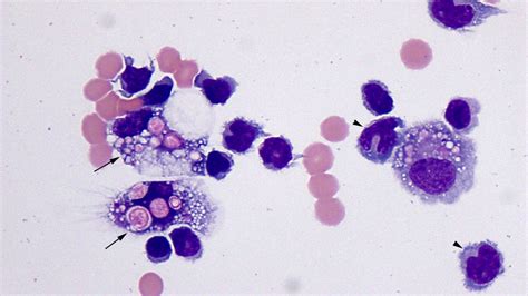 Cerebrospinal Fluid Eclinpath