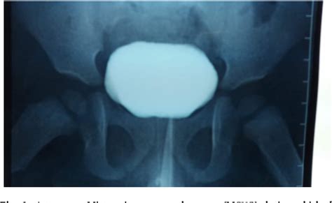 Figure 1 from Primary bladder neck obstruction (PBNO) in children in a ...