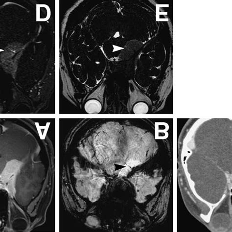 Representative Case 6 A Axial T 1 Weighted Magnetic Resonance Mr Download Scientific