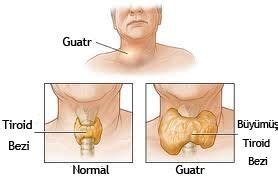 Guatr Nedir Belirtileri Ve Tedavi Y Ntemleri Nelerdir