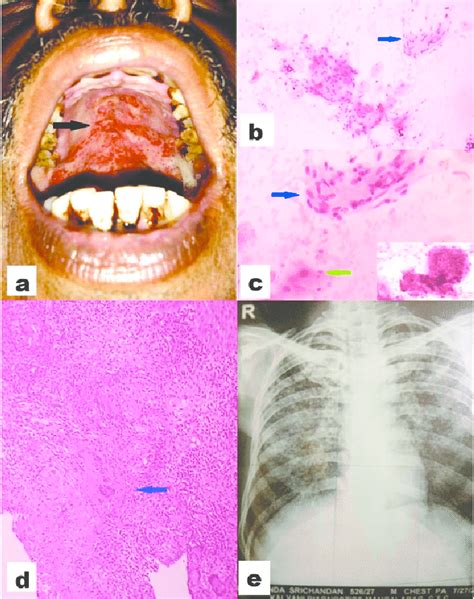 Secondary Oral Tubercular Lesion A Photograph Of Case 2 Showing