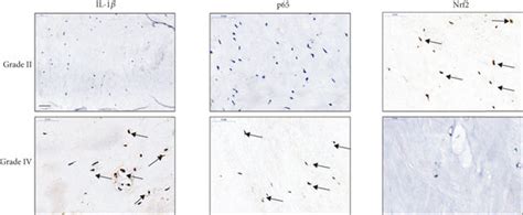 The Protein Expression Of Nrf2 And P65 In Human NP Tissues A The