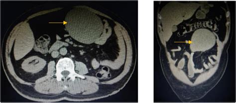 Frontiers An Extremely Rare Case Of Malignant Jejunal Mesenteric