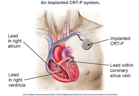 Cardiac Resynchronization Therapy