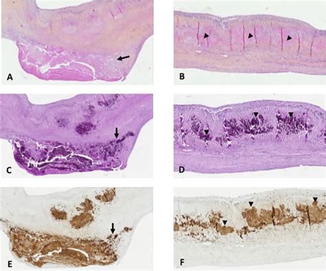 Frontiers A Massive Number Of Extracellular Tropheryma Whipplei In