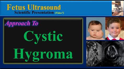 Fetus Ultrasound Cystic Hygroma Youtube