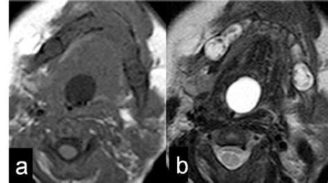 Case 1 Axial Magnetic Resonance Imaging Mri A T1 Weighted And B