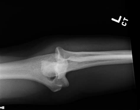 Ortho Dx Elbow Pain And Deformity Following A Martial Arts Injury