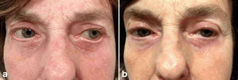 Ectropion After Lower Blepharoplasty