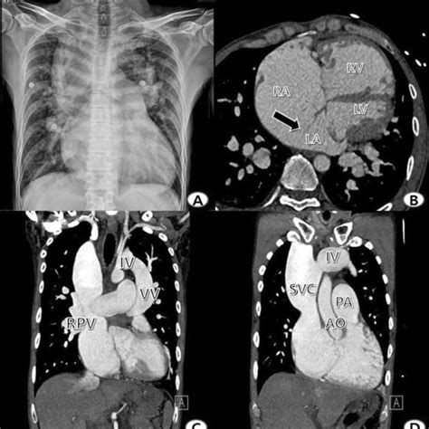 Preoperative Chest X Ray And Computed Tomography Ct A Preoperative