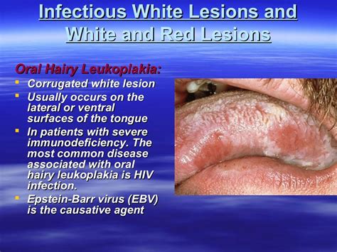 White lesions ppt