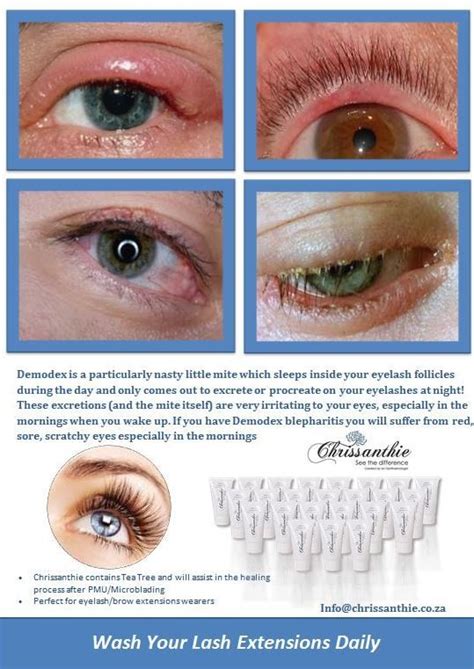 Psoriasis On The Eyelids Symptoms Causes And Treatment Artofit