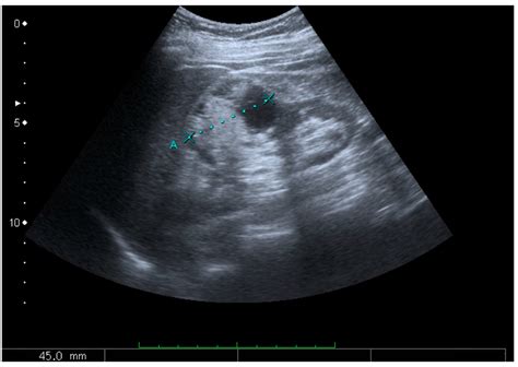 Diagnostics Free Full Text Ultrasonography Of The Kidney A