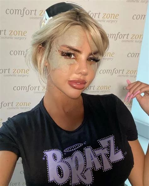 Playboy Star Unveils Swollen Results After Bratz Doll Face Surgery