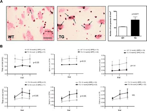 Brain Iron Deposition And Effects Of Iron Chelator Deferiprone Dfp On