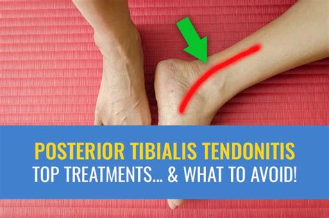 Posterior tibial tendonitis – Top treatments… and what to avoid!