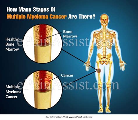 How Many Stages Of Multiple Myeloma Cancer Are There Multiple Myeloma Cancer Myeloma Cancer