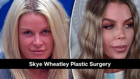 Big Brother Star Skye Wheatley Plastic Surgery Know About Her