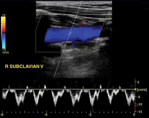 Venous Doppler Sonography Of The Extremities A Window To Off