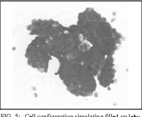 Figure 1 From Four Quadrant Fine Needle Aspiration Cytology For The Detection Of Benign