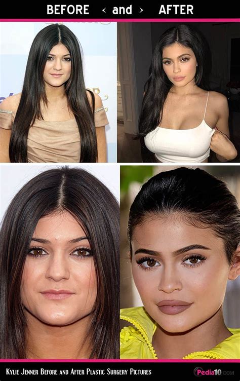 Kylie Jenner Before And After Face Kylie Jenner Before And After Kylie Jenner Lips Kylie