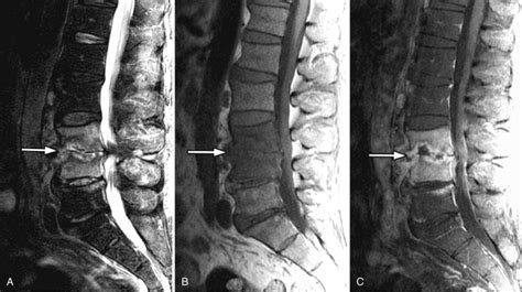 Osteomyelitis And Discitis Spondylodiscitis Radiology Key