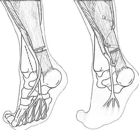 Distal dissection of the flexor hallucis longus tendon (#) (left). ⇒... | Download Scientific ...