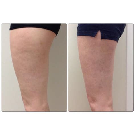 Skin Tightening Body Contouring And Photo Facial Results Before And After Pictures