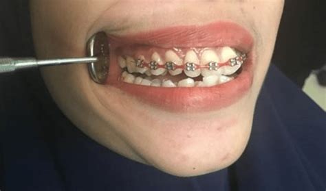 Fitted Fake Braces With No Orthodontic Molar Band And Inaccurate