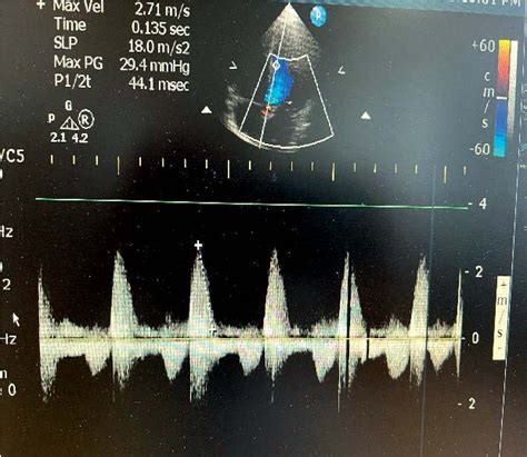 Figure 2 From A Case Of Acute Infective Endocarditis And Septic Shock Semantic Scholar