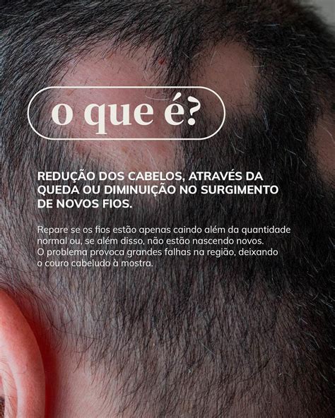 Alopecia androgenética o que é causas e como tratar