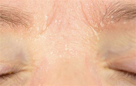 Chalazion: 10 Causes of Chalazion