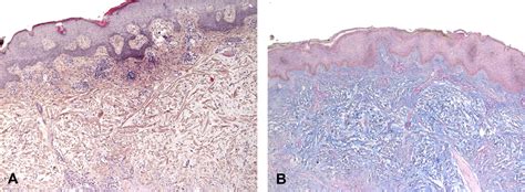 Self Healing Juvenile Cutaneous Mucinosis Clinical And Histopathologic