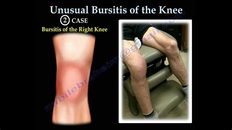 Unusual Bursitis Of The Knee Everything You Need To Know Dr Nabil Ebraheim Youtube