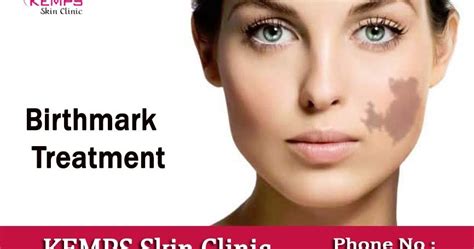 Birthmark Types, Causes, and treatment | KEMPS Skin Clinic