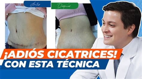 Cómo quitar las cicatrices post quirúrgicas Medicina estética en Perú