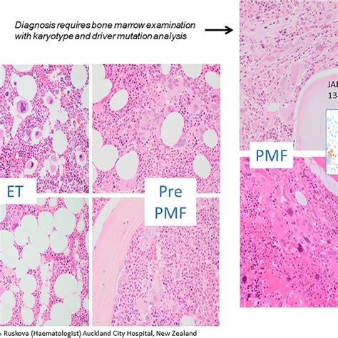 Bone Marrow Morphology In Prefibrotic Vs Overtly Fibrotic Myelofibrosis