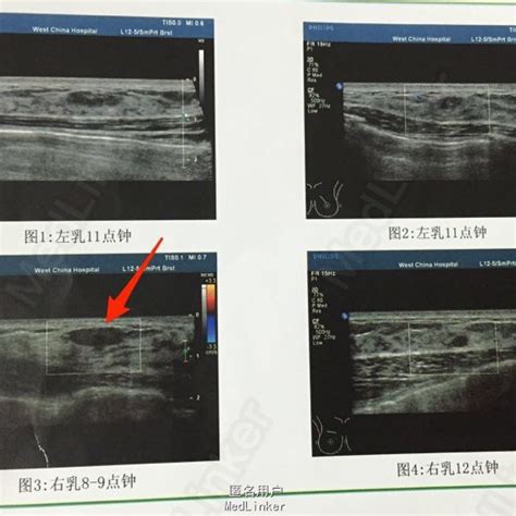 双乳纤维腺瘤 医联