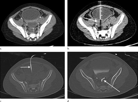 Image Guided Transvesicular Drainage Of Pelvic Fluid Collections A