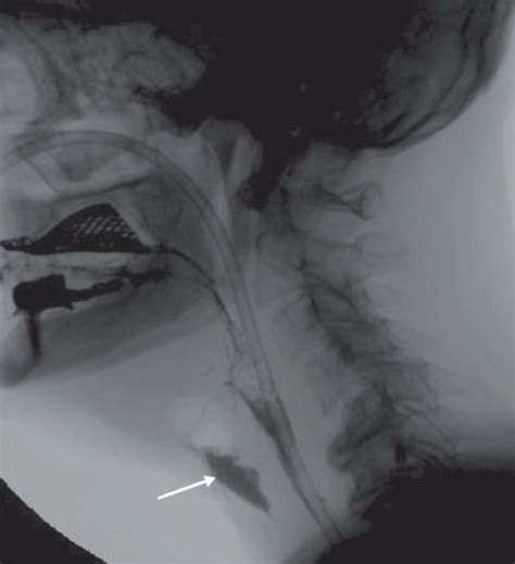 Lateral Fluoroscopic Views Of A Year Old Man Who Has Undergone A