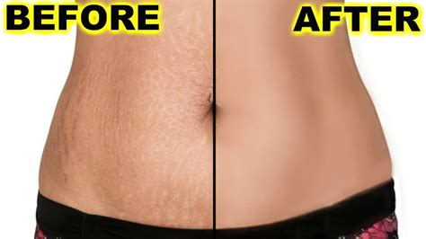 How To Remove Stretch Marks Permanently In 5 Days Remove Stretch