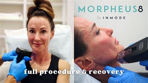 Morpheus 8 Radio Frequency Microneedling Treatment Before After