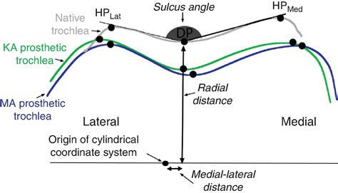 Strategies for Improving the Prosthetic Trochlea Design Based on ...