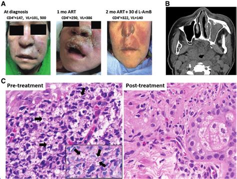 Clinical Evolution Of Mucosal Leishmaniasis In Hiv Related Immune